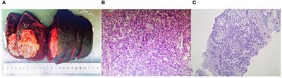 Case report: Thyroid metastasis from hepatocellular carcinoma: a rare case with diffuse solid occupancy and unusual imaging findings